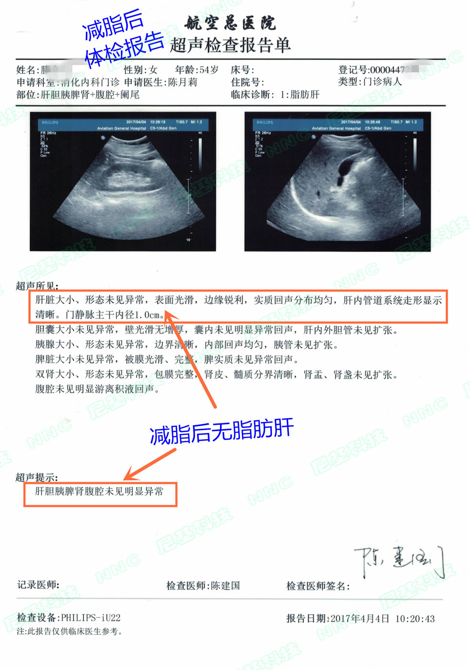 这些数据证明中度脂肪肝已经消失